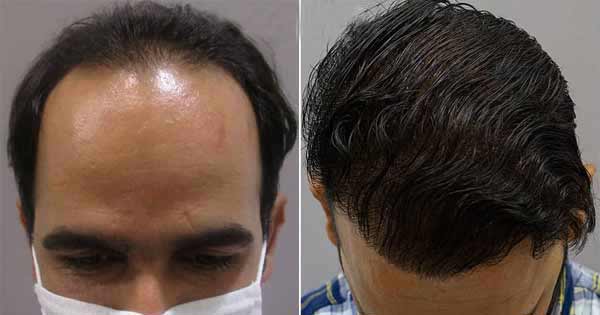 کاشت مو اصفهان